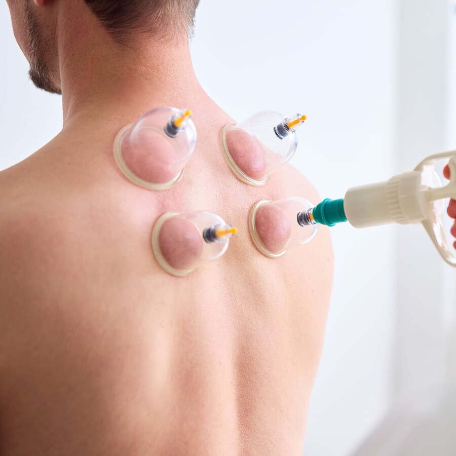 Nahaufnahme des R&uuml;ckens eines Patienten bei der Schr&ouml;pfungstherapie.